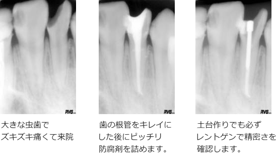 歯の根の治療例